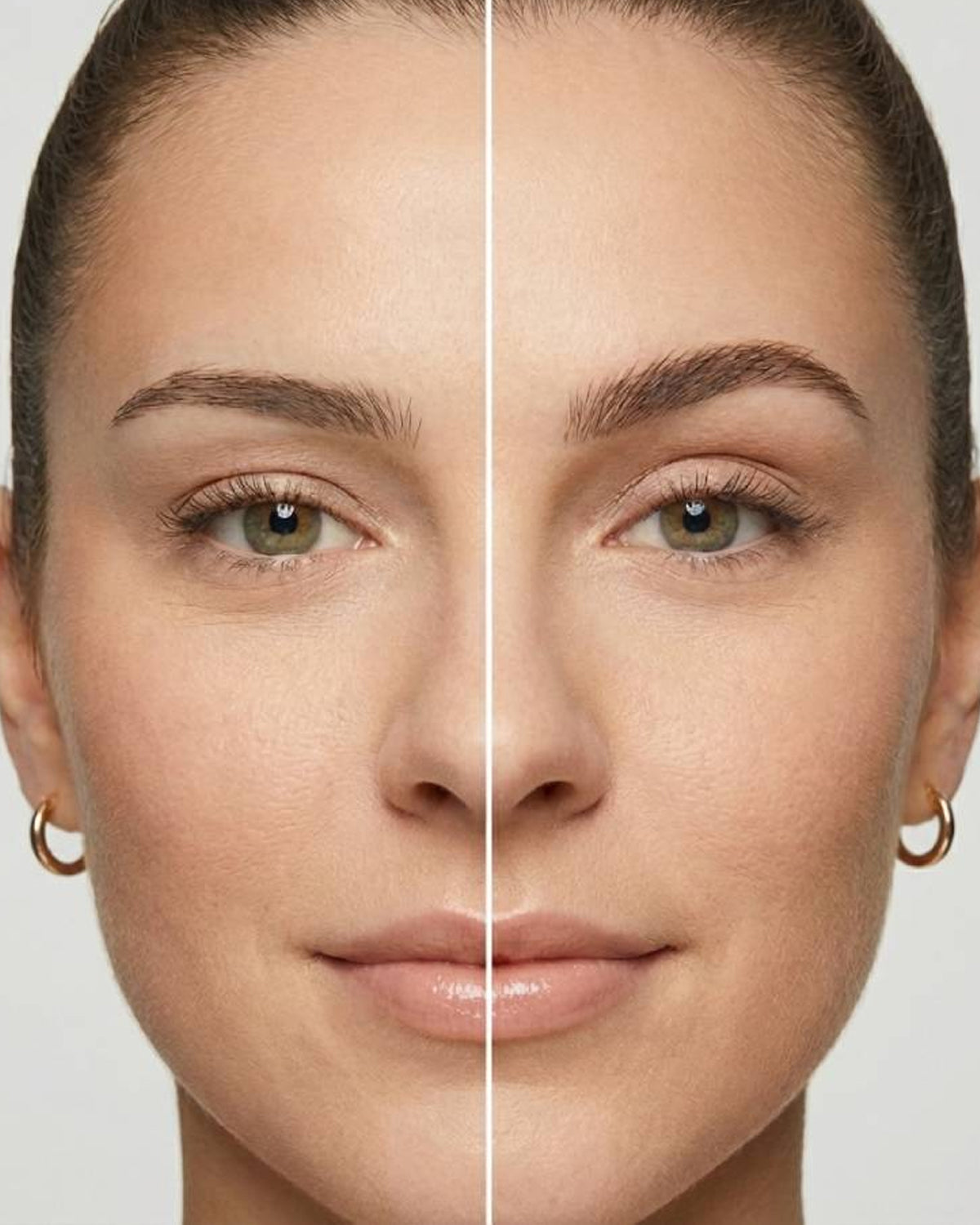 Brow Botox