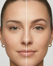 Brow Botox