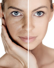 IPL Photofacial